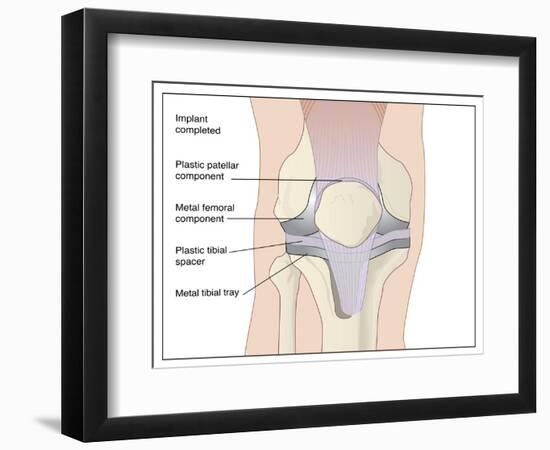 Knee Replacement, Artwork-Peter Gardiner-Framed Photographic Print