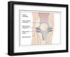 Knee Replacement, Artwork-Peter Gardiner-Framed Photographic Print