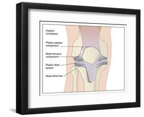 Knee Replacement, Artwork-Peter Gardiner-Framed Photographic Print