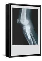 Knee Replacement-null-Framed Stretched Canvas