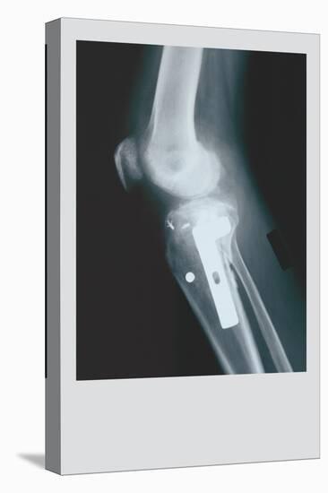 Knee Replacement-null-Stretched Canvas