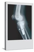 Knee Replacement-null-Stretched Canvas