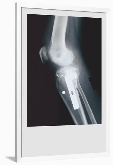 Knee Replacement-null-Framed Art Print