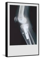 Knee Replacement-null-Framed Stretched Canvas
