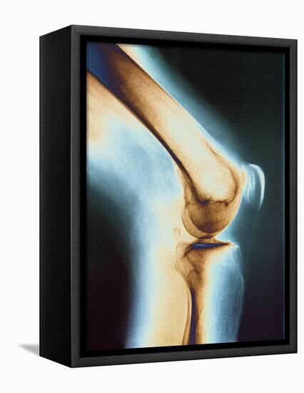 Knee X-ray-null-Framed Stretched Canvas