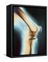 Knee X-ray-null-Framed Stretched Canvas