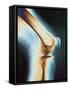 Knee X-ray-null-Framed Stretched Canvas