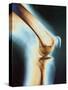 Knee X-ray-null-Stretched Canvas
