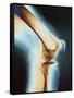 Knee X-ray-null-Framed Stretched Canvas