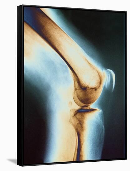 Knee X-ray-null-Framed Stretched Canvas