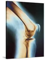 Knee X-ray-null-Stretched Canvas
