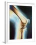 Knee X-ray-null-Framed Premium Photographic Print