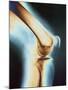 Knee X-ray-null-Mounted Premium Photographic Print