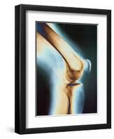 Knee X-ray-null-Framed Photographic Print