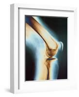 Knee X-ray-null-Framed Photographic Print