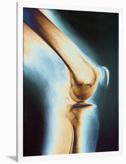 Knee X-ray-null-Framed Photographic Print