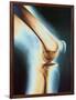 Knee X-ray-null-Framed Photographic Print