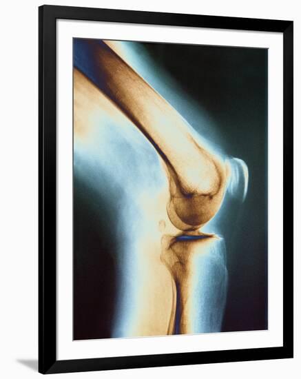Knee X-ray-null-Framed Photographic Print