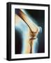 Knee X-ray-null-Framed Photographic Print