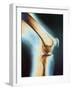 Knee X-ray-null-Framed Photographic Print