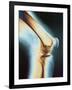 Knee X-ray-null-Framed Photographic Print