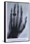 Konrad Roentgen's X-Ray of the Hand of Showing Bones and the Ring, 1895-null-Framed Stretched Canvas