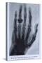 Konrad Roentgen's X-Ray of the Hand of Showing Bones and the Ring, 1895-null-Stretched Canvas