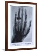 Konrad Roentgen's X-Ray of the Hand of Showing Bones and the Ring, 1895-null-Framed Art Print