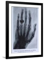 Konrad Roentgen's X-Ray of the Hand of Showing Bones and the Ring, 1895-null-Framed Art Print