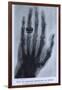 Konrad Roentgen's X-Ray of the Hand of Showing Bones and the Ring, 1895-null-Framed Art Print