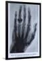 Konrad Roentgen's X-Ray of the Hand of Showing Bones and the Ring, 1895-null-Framed Art Print