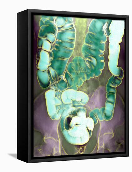 Large Intestine, X-ray-Du Cane Medical-Framed Stretched Canvas