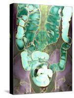 Large Intestine, X-ray-Du Cane Medical-Stretched Canvas