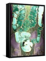 Large Intestine, X-ray-Du Cane Medical-Framed Stretched Canvas