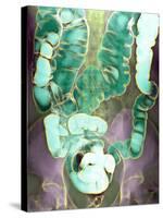 Large Intestine, X-ray-Du Cane Medical-Stretched Canvas