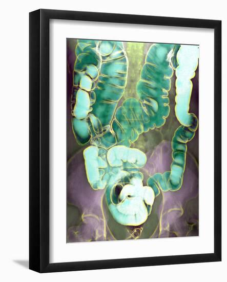 Large Intestine, X-ray-Du Cane Medical-Framed Photographic Print