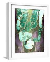 Large Intestine, X-ray-Du Cane Medical-Framed Photographic Print