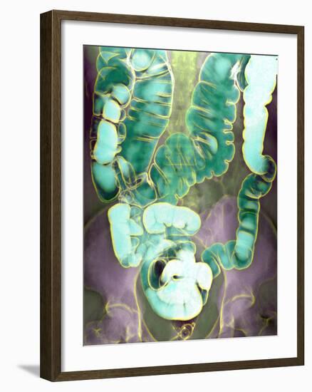 Large Intestine, X-ray-Du Cane Medical-Framed Photographic Print