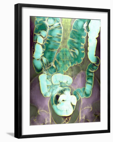 Large Intestine, X-ray-Du Cane Medical-Framed Photographic Print