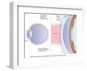 Laser Eye Surgery, Artwork-Peter Gardiner-Framed Photographic Print