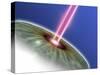 Laser Eye Surgery, Computer Artwork-PASIEKA-Stretched Canvas