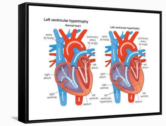 Left Ventricular Hypertrophy-Encyclopaedia Britannica-Framed Stretched Canvas