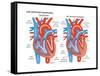 Left Ventricular Hypertrophy-Encyclopaedia Britannica-Framed Stretched Canvas