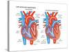 Left Ventricular Hypertrophy-Encyclopaedia Britannica-Stretched Canvas