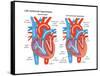 Left Ventricular Hypertrophy-Encyclopaedia Britannica-Framed Stretched Canvas