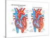 Left Ventricular Hypertrophy-Encyclopaedia Britannica-Stretched Canvas