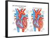 Left Ventricular Hypertrophy-Encyclopaedia Britannica-Framed Poster