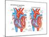 Left Ventricular Hypertrophy-Encyclopaedia Britannica-Mounted Poster