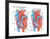 Left Ventricular Hypertrophy-Encyclopaedia Britannica-Framed Poster