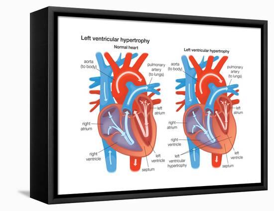 Left Ventricular Hypertrophy-Encyclopaedia Britannica-Framed Stretched Canvas